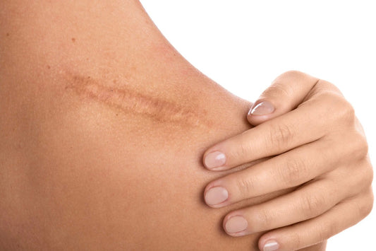 Tallow Cream for Scars
