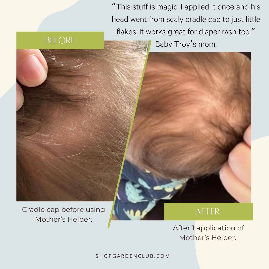 Cradle cap before and after with tallow cream