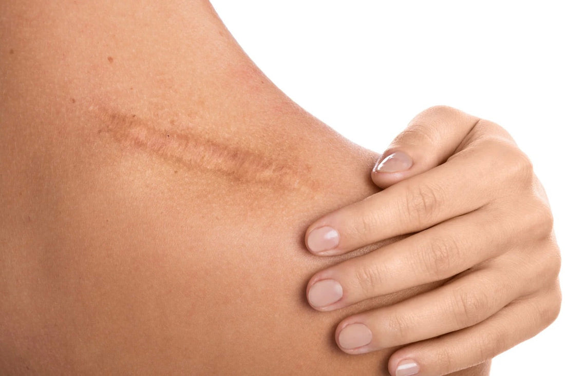 Tallow Cream for Scars